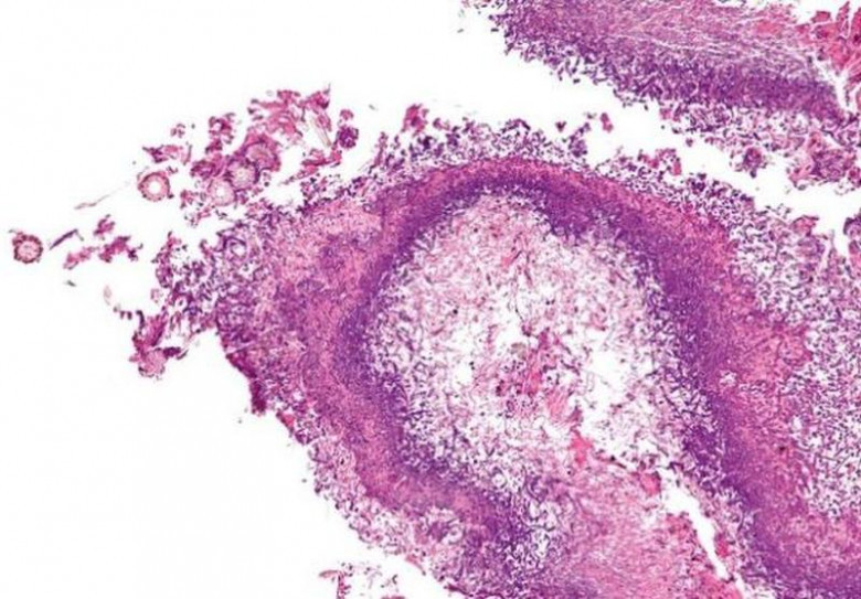 6. Aspergillus fumigatus