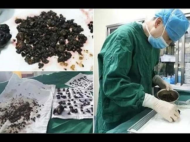200 камней в одном желчном пузыре