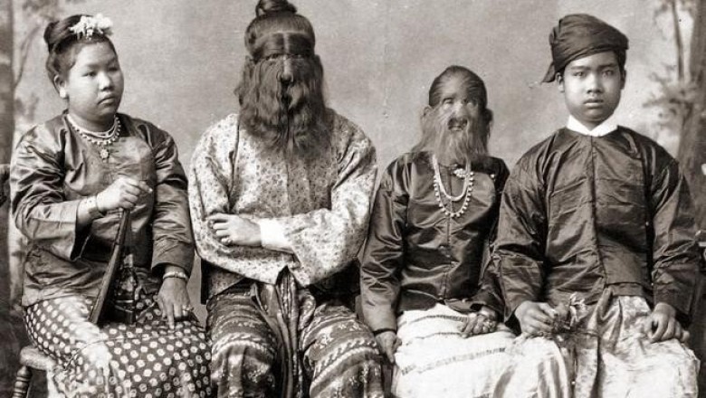 Исторические снимки Чарльза Эйзенмана людей с генетическими аномалиями