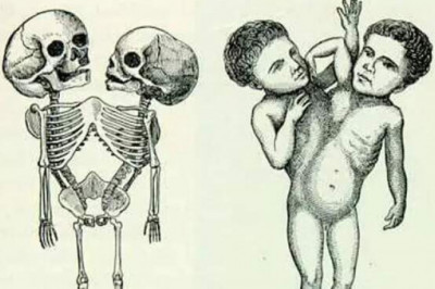 «Бидденденские девицы», «символы божественного гнева» и другие самые знаменитые сиамские близнецы