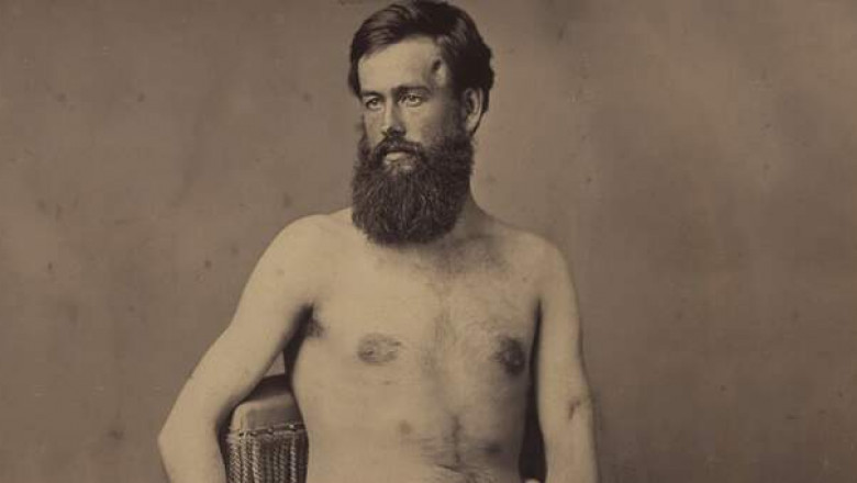 Раны Гражданской войны в США: фотографии солдат, получившие ранения в одной из самых кровавых войн XIX века