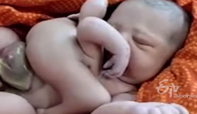 Индианка родила малыша с четырьмя руками и ногами