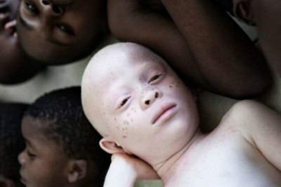 Почему лучше не рождаться альбиносом в Африке